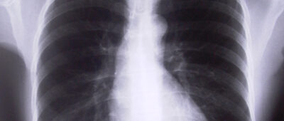 El Supremo considera accidente laboral un edema pulmonar fuera del centro de trabajo